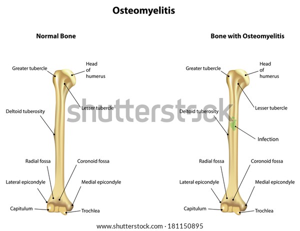 Humerus Bone Diagram Labeled 8731