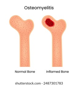 Osteomyelitis of Normal Bone and Inflamed Bone