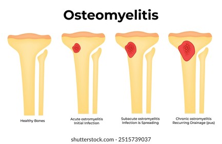 Diagrama de ilustração vetorial do projeto científico da osteomielite