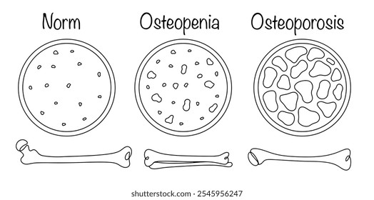 Osteopenia y osteoporosis. Afección en la que hay una disminución difusa en el volumen de masa ósea en el cuerpo. Estructura ósea y tejido óseo normales dibujados a mano en la enfermedad. Vector aislado.