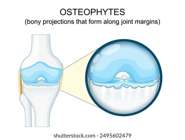 Osteophyte. Anatomy of human knee joint Osteoarthritis . Bone spurs. Close-up of a Synovial Joint with cartilage degeneration. Osteophyte formation. Vector illustration