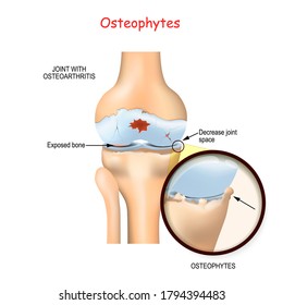 Osteophyte. Human knee joint with osteoarthritis. Close up of spurs and narrowing of the joint space.