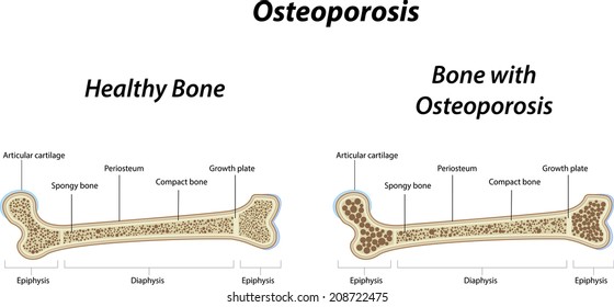 1,612 Brittle bones Images, Stock Photos & Vectors | Shutterstock