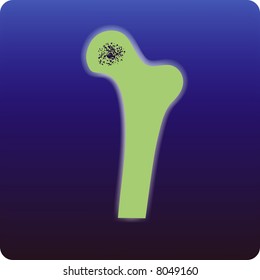 Osteoporosis