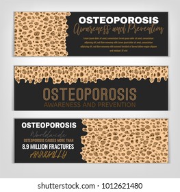 Osteoporosis banners set. Healthcare, medicine and early prevention concept. Landscape layout. Vector illustration with bone texture in beige, bronze, grey and white colors.