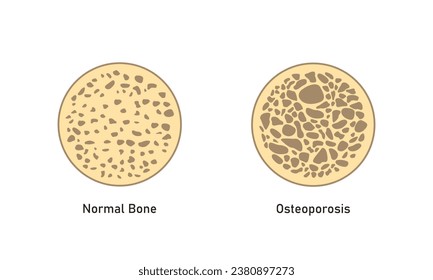 Osteoporosis (BMD) Concept Design. Vector Illustration.	