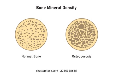 Osteoporosis (BMD) Concept Design. Vector Illustration.