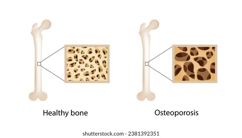 Osteoporosis, enfermedad ósea.  Cierre de la densidad de médula ósea (DMO). Proceso de envejecimiento. Concepto médico. Ilustración vectorial.