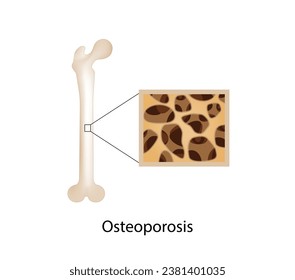 Osteoporosis, enfermedad ósea.  Cierre de la densidad de médula ósea (DMO). Proceso de envejecimiento. Concepto médico. Ilustración vectorial.