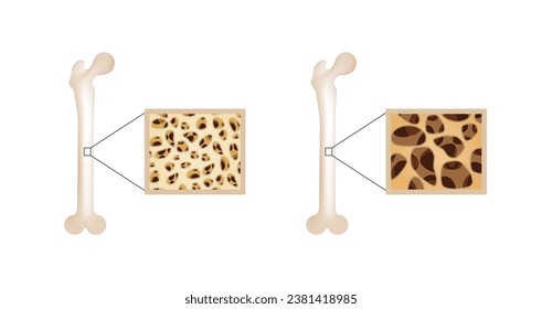 Osteoporosis, enfermedad ósea. Cierre de la densidad de médula ósea (DMO). Proceso de envejecimiento. Concepto médico. Ilustración vectorial.