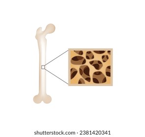 Osteoporosis, enfermedad ósea. Cierre de la densidad de médula ósea (DMO). Proceso de envejecimiento. Concepto médico. Ilustración vectorial.