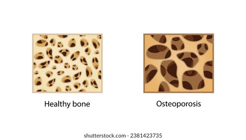 Osteoporosis, enfermedad ósea. Cierre de la densidad de médula ósea (DMO). Proceso de envejecimiento. Concepto médico. Ilustración vectorial.