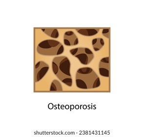 Osteoporosis, enfermedad ósea. Cierre de la densidad de médula ósea (DMO). Proceso de envejecimiento. Concepto médico. Ilustración vectorial.