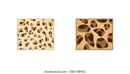 Osteoporosis, enfermedad ósea. Cierre de la densidad de médula ósea (DMO). Proceso de envejecimiento. Concepto médico. Ilustración vectorial.