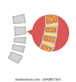 Osteoporosis. concepto de enfermedad ósea. Ilustración vectorial