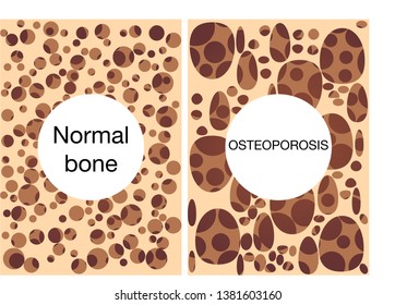 687 Osteoporosis texture Images, Stock Photos & Vectors | Shutterstock