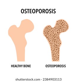 Osteoporosis ósea y hueso sano en diseño plano sobre fondo blanco.