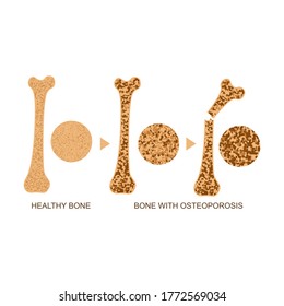 Osteoporosis Bone Infographics Concept Card Poster Ad Medical Human Health. Vector illustration of Healthy and with Disease, Fracture