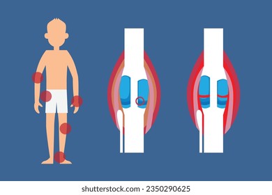 Osteoporosis y pérdida de hueso Concepto de ilustración vectorial 2d para banner, sitio web, página de aterrizaje, volante, etc