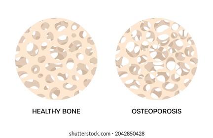 Hueso sano y osteoporosis, ilustraciones redondas sobre fondo blanco