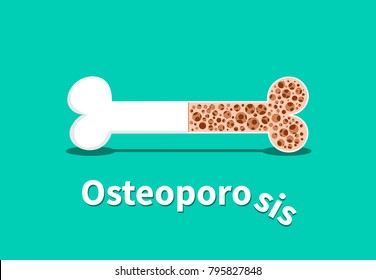 Osteoporosis, Bone Structure In Vector Design