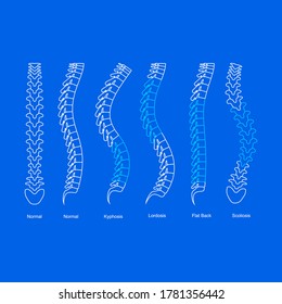 Osteoporosis Bone Types Infographics Concept Card Poster Contour Linear Style Include of Scoliosis, Kyphosis, Lordosis and Normal. Vector illustration of Backbone