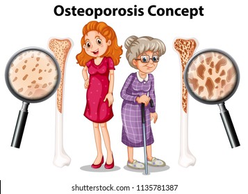 Osteoporosis concept on white background illustration