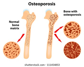 Osteoporosis is a disease of bones that leads to an increased risk of fracture. Vector scheme