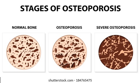 Osteoporosis is a disease characterized by low bone mass and deterioration of bone tissue, leading to fragility and fractures. 