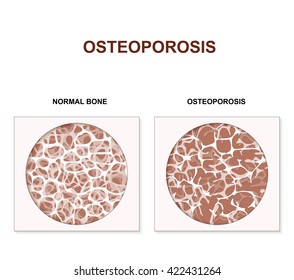 Osteoporosis is a disease characterized by low bone mass and deterioration of bone tissue, leading to fragility and fractures. 