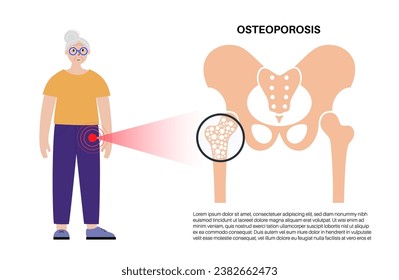 Osteoporosis disease concept. Systemic skeletal disorder, loss of bone mineral density. Increased risk of hip fracture in older women. Morbidity and mortality in the elderly, flat vector illustration