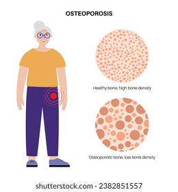 Osteoporosis disease concept. Systemic skeletal disorder, loss of bone mineral density. Increased risk of hip fracture in older women. Morbidity and mortality in the elderly, flat vector illustration