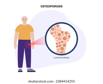 Osteoporosis disease concept. Systemic skeletal disorder, loss of bone mineral density. Increased risk of hip fracture in older men. Morbidity and mortality in the elderly, flat vector illustration