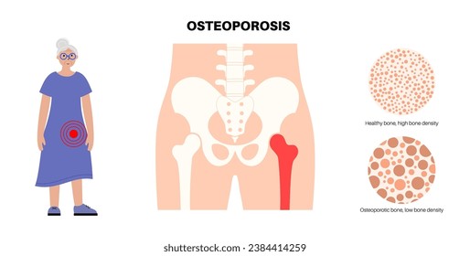 Osteoporosis disease concept. Systemic skeletal disorder, loss of bone mineral density. Increased risk of hip fracture in older women. Morbidity and mortality in the elderly, flat vector illustration