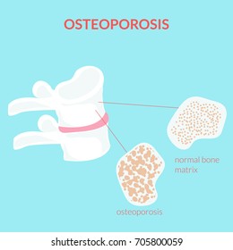 Osteoporosis Disease Infographic. Vector Medical Illustration.