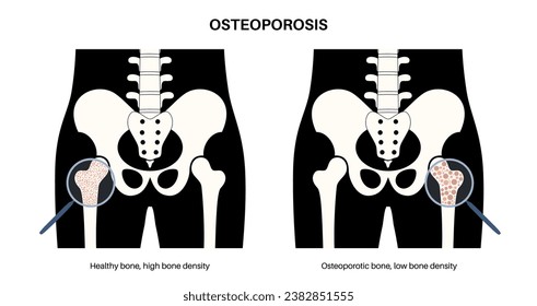 Osteoporosis disease poster. Systemic skeletal disorder, loss of bone mineral density. Normal and unhealthy bones. Increased risk of hip fracture. Deterioration of bone tissue flat vector illustration