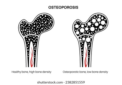 Afiche de la enfermedad de la osteoporosis. Trastorno esquelético sistémico, pérdida de densidad mineral ósea. Hueso normal e insalubre. Aumento del riesgo de fractura de cadera. Deterioro del tejido óseo ilustración vectorial plana