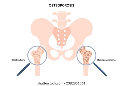 Osteoporosis disease poster. Systemic skeletal disorder, loss of bone mineral density. Normal and unhealthy bones. Increased risk of hip fracture. Deterioration of bone tissue flat vector illustration