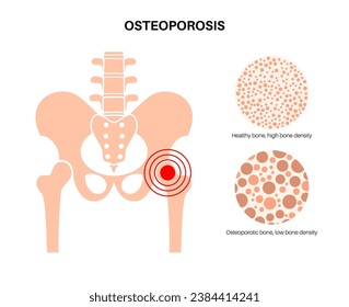 Osteoporosis disease poster. Systemic skeletal disorder, loss of bone mineral density. Normal and unhealthy bones. Increased risk of hip fracture. Deterioration of bone tissue flat vector illustration