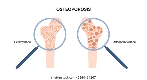 Osteoporosis disease poster. Systemic skeletal disorder, loss of bone mineral density. Normal and unhealthy bones. Increased risk of hip fracture. Deterioration of bone tissue flat vector illustration