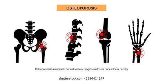 Osteoporosis disease poster. Systemic skeletal disorder of spine, wrist, and femur, loss of bone mineral density. Increased risk of hip fracture. Deterioration of bone tissue flat vector illustration