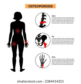 Osteoporosis disease poster. Systemic skeletal disorder of spine, wrist, and femur, loss of bone mineral density. Increased risk of hip fracture. Deterioration of bone tissue flat vector illustration