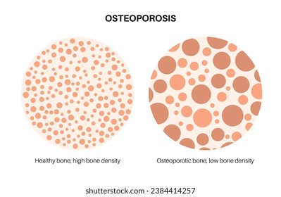 Afiche de la enfermedad de la osteoporosis. Trastorno esquelético sistémico, pérdida de densidad mineral ósea. Hueso normal e insalubre. Aumento del riesgo de fractura de cadera. Deterioro del tejido óseo ilustración vectorial plana