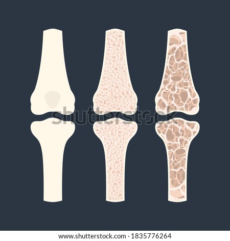 Osteoporosis disease stages. Bone density loss infographic banner. Normal bone versus osteoporotic bone. Skeletal system disease. Health care and medical concept. Vector illustration.