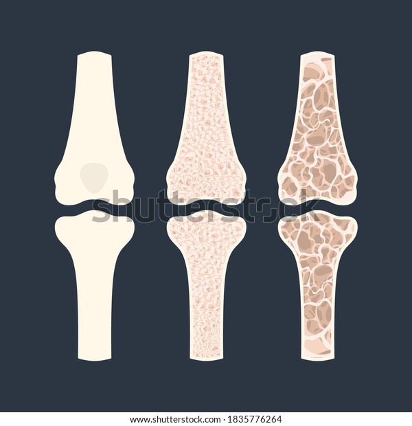 Osteoporosis\
disease stages. Bone density loss infographic banner. Normal bone\
versus osteoporotic bone. Skeletal system disease. Health care and\
medical concept. Vector\
illustration.