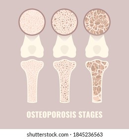 Osteoporosis disease stages from healthy to severe  Bone density loss infographic banner  Normal bone becoming osteoporotic bone  Skeletal system disease  Health care concept  Vector illustration 