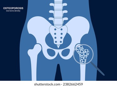 Osteoporosis disease. Systemic skeletal disorder, loss of bone mineral density. Increased risk of hip fracture, morbidity and mortality in the elderly. Deterioration of bone tissue vector illustration