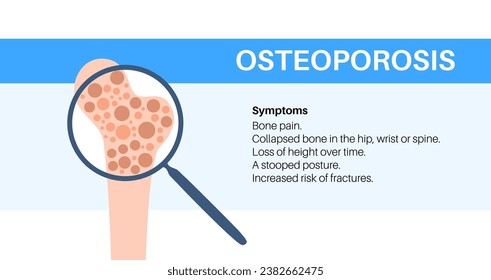 Enfermedad por osteoporosis. Trastorno esquelético sistémico, pérdida de densidad mineral ósea. Aumento del riesgo de fractura de cadera, morbilidad y mortalidad en ancianos. Deterioro de la ilustración del vector del tejido óseo