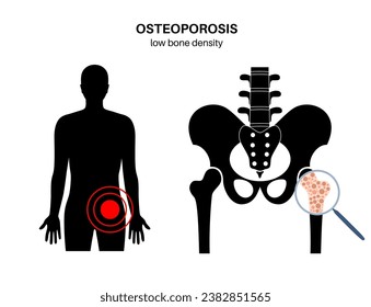 Osteoporosis disease. Systemic skeletal disorder, loss of bone density. Normal and unhealthy bones in the human body. Increased risk of fractures. Deterioration of bone tissue vector flat illustration