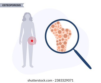 Enfermedad por osteoporosis. Trastorno esquelético sistémico, pérdida de densidad ósea. Hueso normal e insalubre en el cuerpo de la mujer. Aumento del riesgo de fracturas. Deterioro del vector de tejido óseo ilustración plana